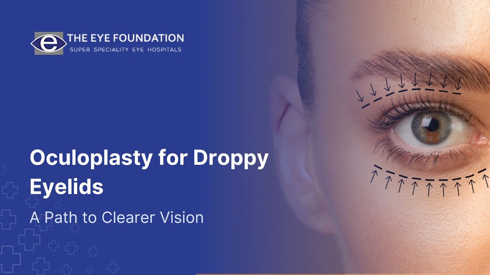 oculoplasty-droopy-eyelids-clearer-vision