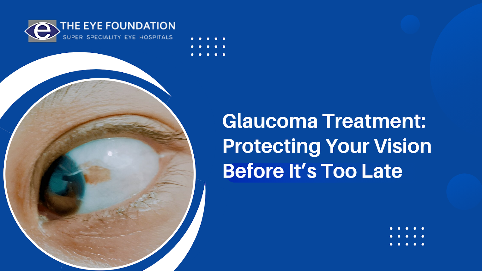glaucoma-treatment-to-protect-vision