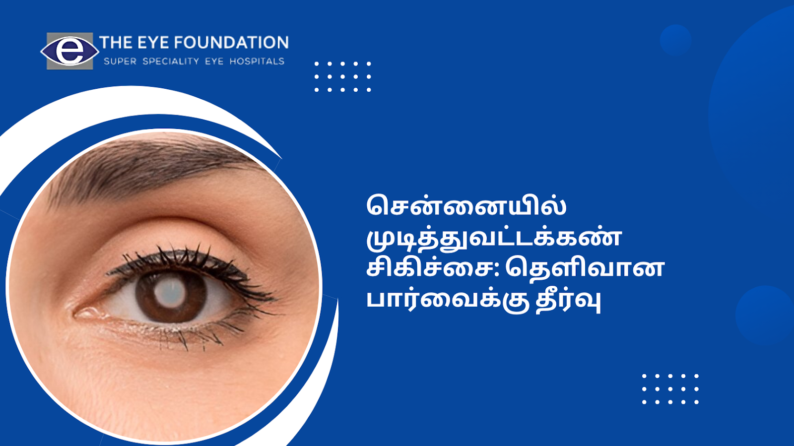 சென்னையில் முடித்துவட்டக்கண் சிகிச்சை