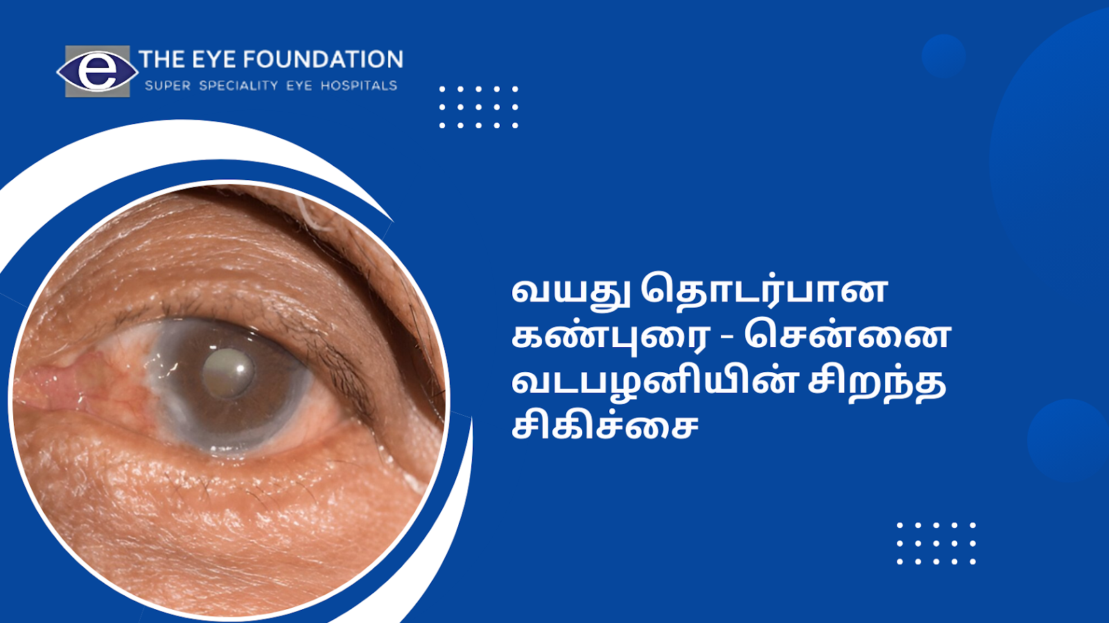 age-related-cataract-treatment-permanent-solutions-vadapalani-chennai