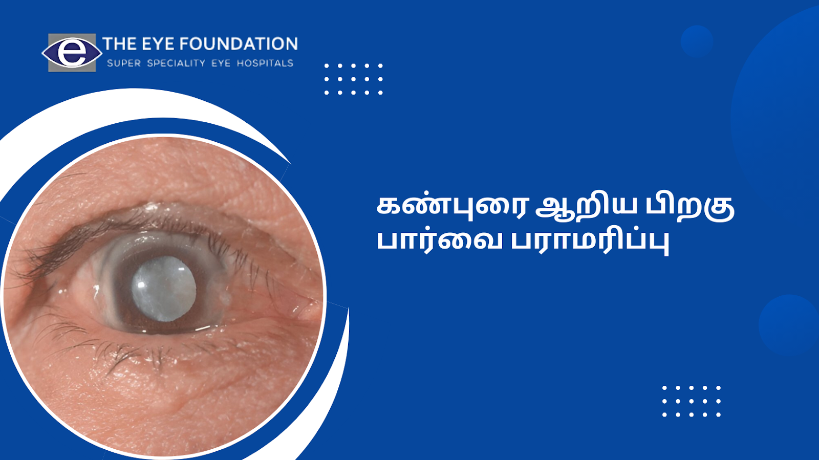 கண்புரை ஆறிய பிறகு பார்வை பராமரிப்பு