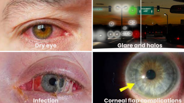 risk-and-side-effects-of-contoura-lasik