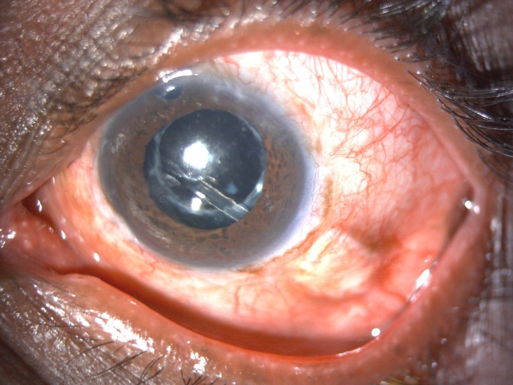 Advanced Treatment for Glaucoma in Eye Foundation -  Glaucoma Drainage Device