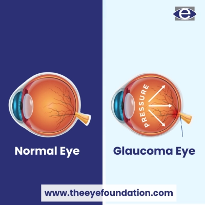 Best Glaucoma Treatment In South India