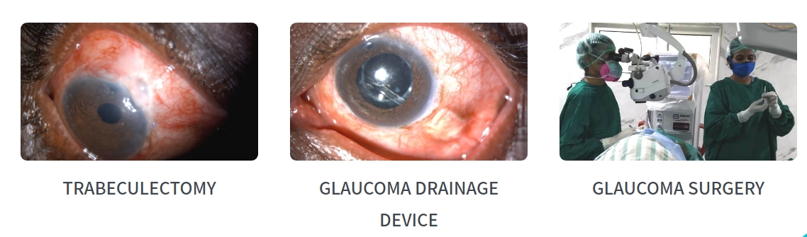 Glaucoma Surgery