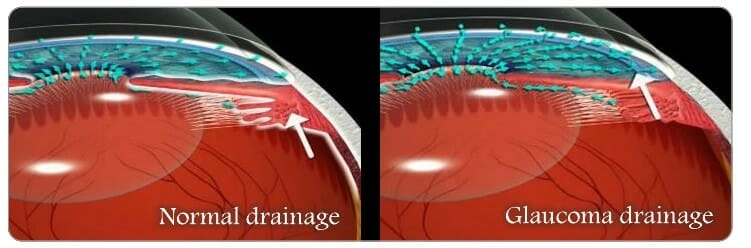 Best Glaucoma Treatment In South India