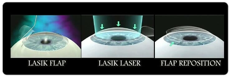 Lasik or Laser treatment in the eye Foundation 