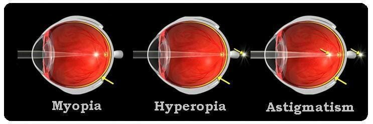 Types of Eye Sight Proplems - Myopia, hyperopia, Astigmatism