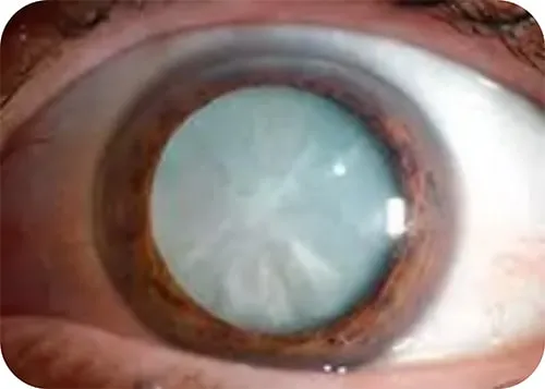 Cataract Eye Image - mature-cataract
