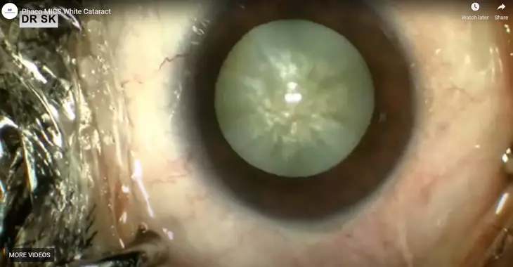 Bladeless Cataract Eye Surgery - Advanced Laser Cataract Operation