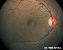 what-is-Retina