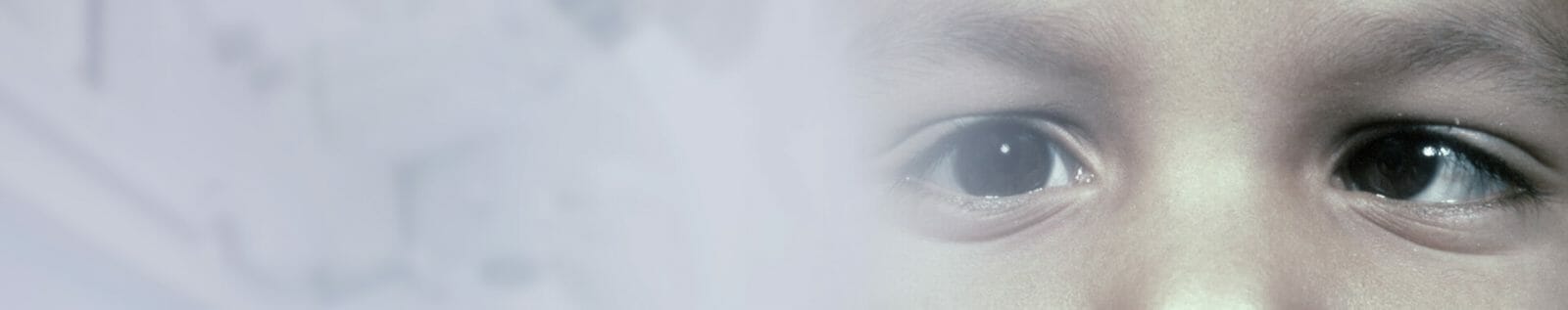 Squint-&-Paediatric-Ophthalmology
