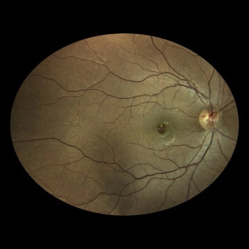 Macular-Hole