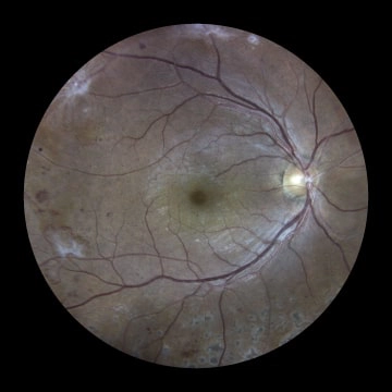 Proliferative-Diabetic-Retinopathy